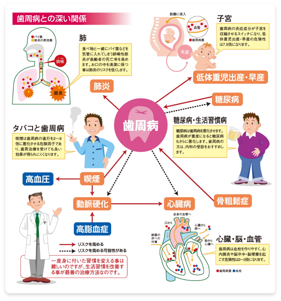 歯周病と治療について