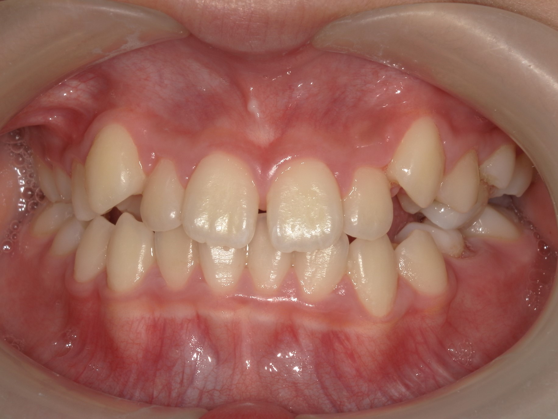 Before